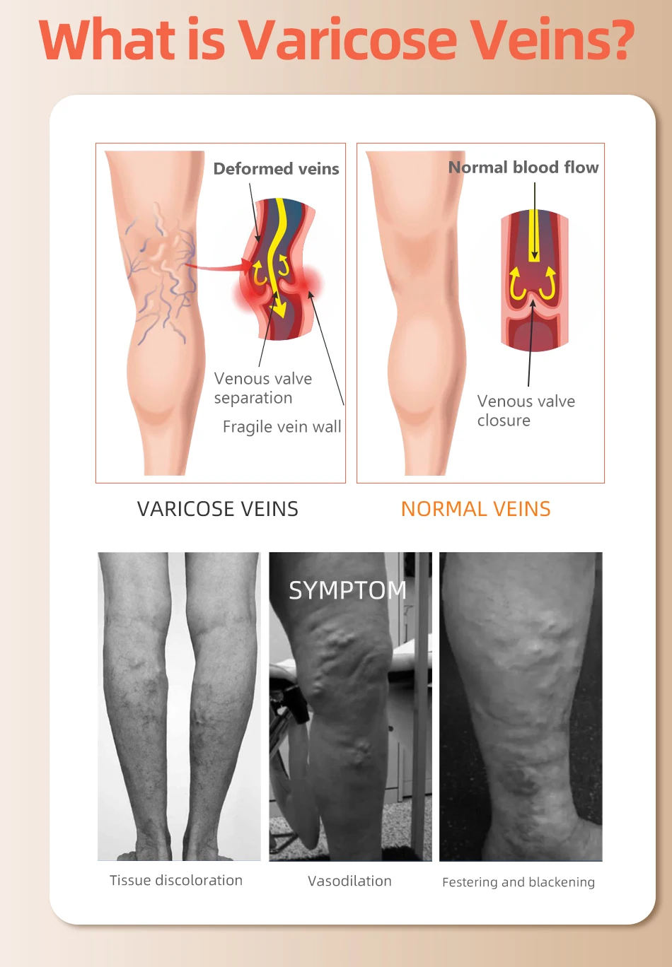 30-40 MmHg Over Knee Closed To - Compression Sock Medical recension och pris